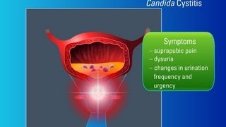 Candiduria: Risk Factors, Symptoms and Treatment