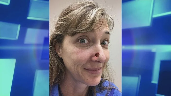 Tanning Addicts Facial Reconstruction after Skin C...