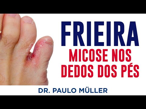 Vídeo: 3 maneiras de aliviar uma ferida no dedo do pé