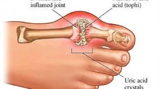 7 Foods To Naturally Decrease Uric Acid In The Body