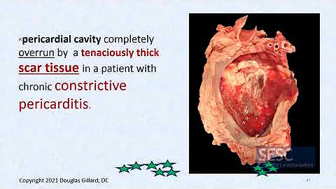 CVPP: (WK7) (Thursday) (SPR 21):Cardiac tamponade,...