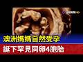 澳洲媽媽自然受孕 誕下罕見同卵4胞胎
