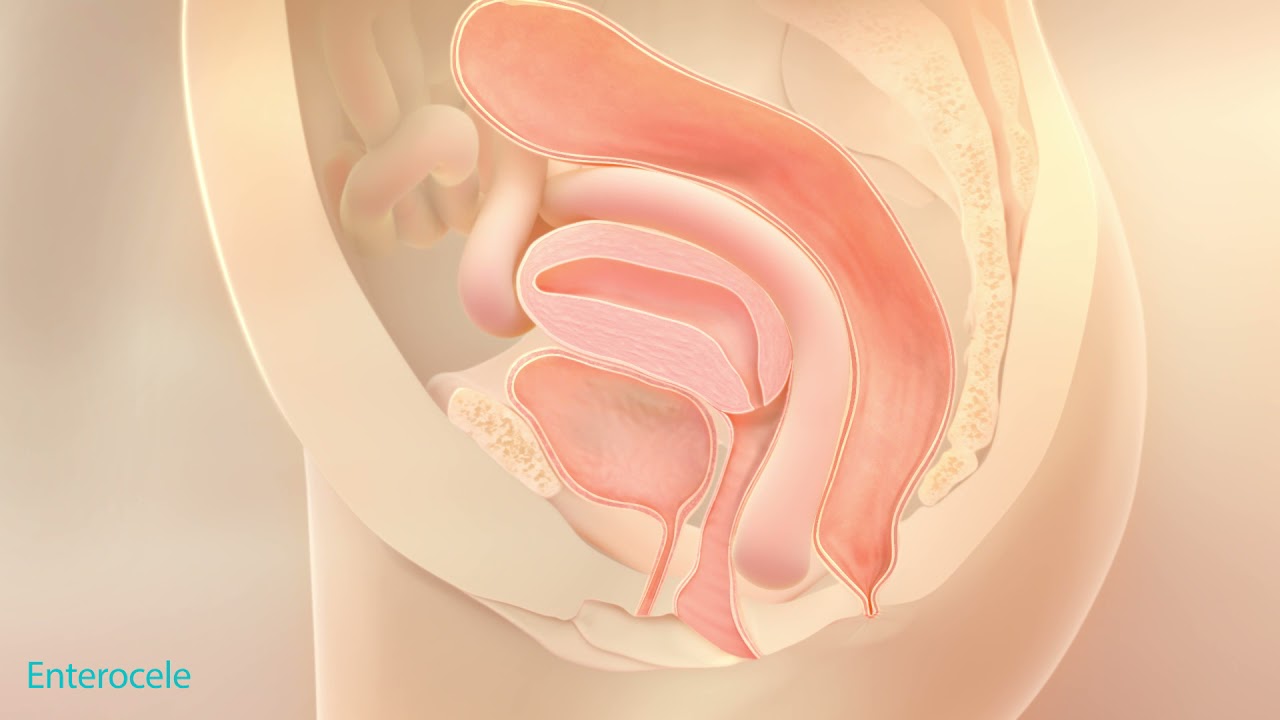 Pelvic Organ Prolapse for Women | Bucks County, Pennsylvania | FPHC, image size:1280x720