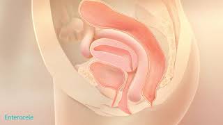 Pelvic Organ Prolapse - Patient Animation Disease States