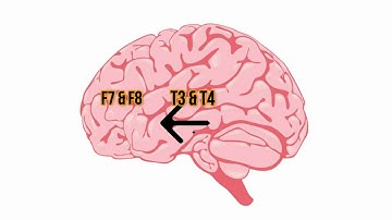 RMTD Normal Variant EEG - Studying for Abret Board Exam