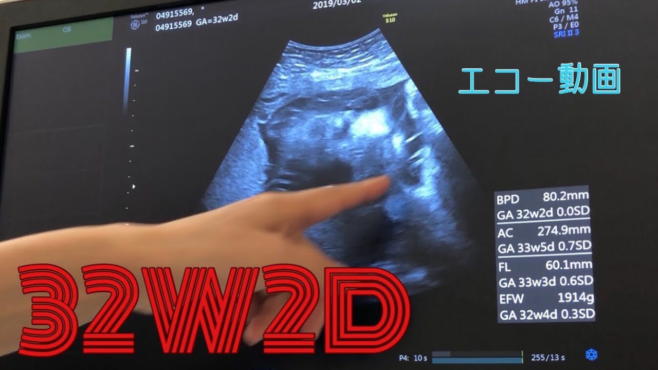 32週2日 32w2d 妊娠9ヶ月 逆子の赤ちゃん 超音波エコー動画 Youtube