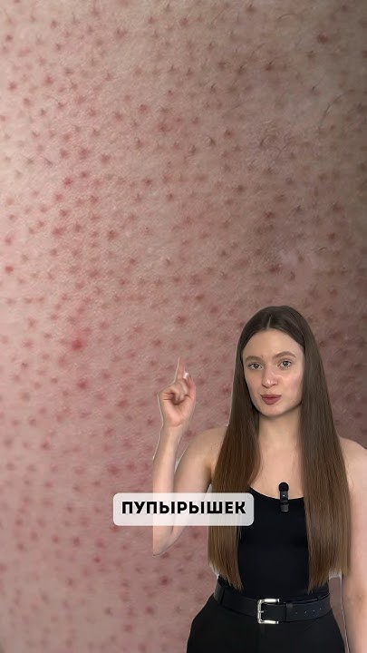 Не можешь избавиться от ПУПЫРЫШЕК Арт. на WB ️139625239 пенка ️ ...