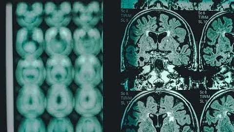 Alzheimer's Disease - One Step Closer to Finding a Cure