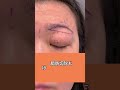 重たい目元をスッキリさせる眉下リフトと脂肪切除!#眉下リフト #眉下切開 #整形