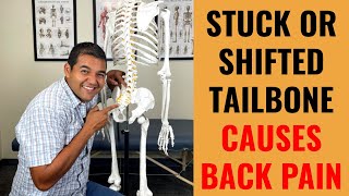 Can A Stuck Or Shifted Tailbone Cause Lower Back Pain? [How To Fix It]