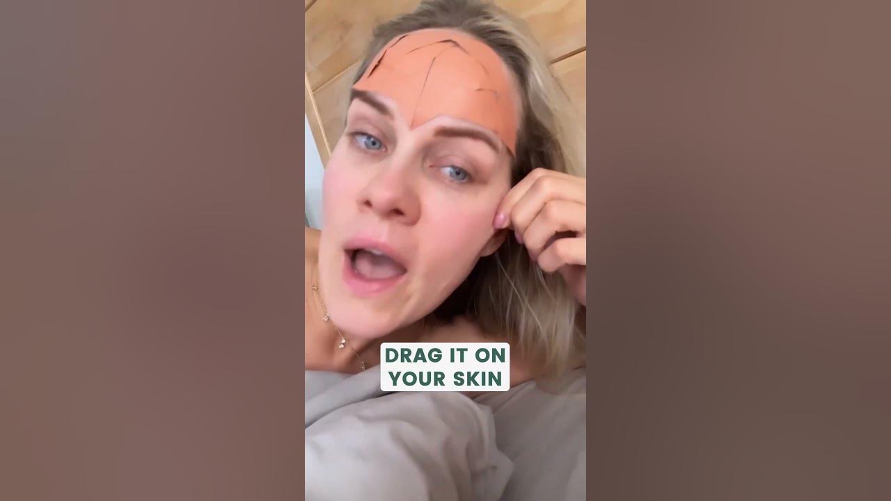 ⚠️ Microneedling gone wrong! Here’s how it can leave you scarred for