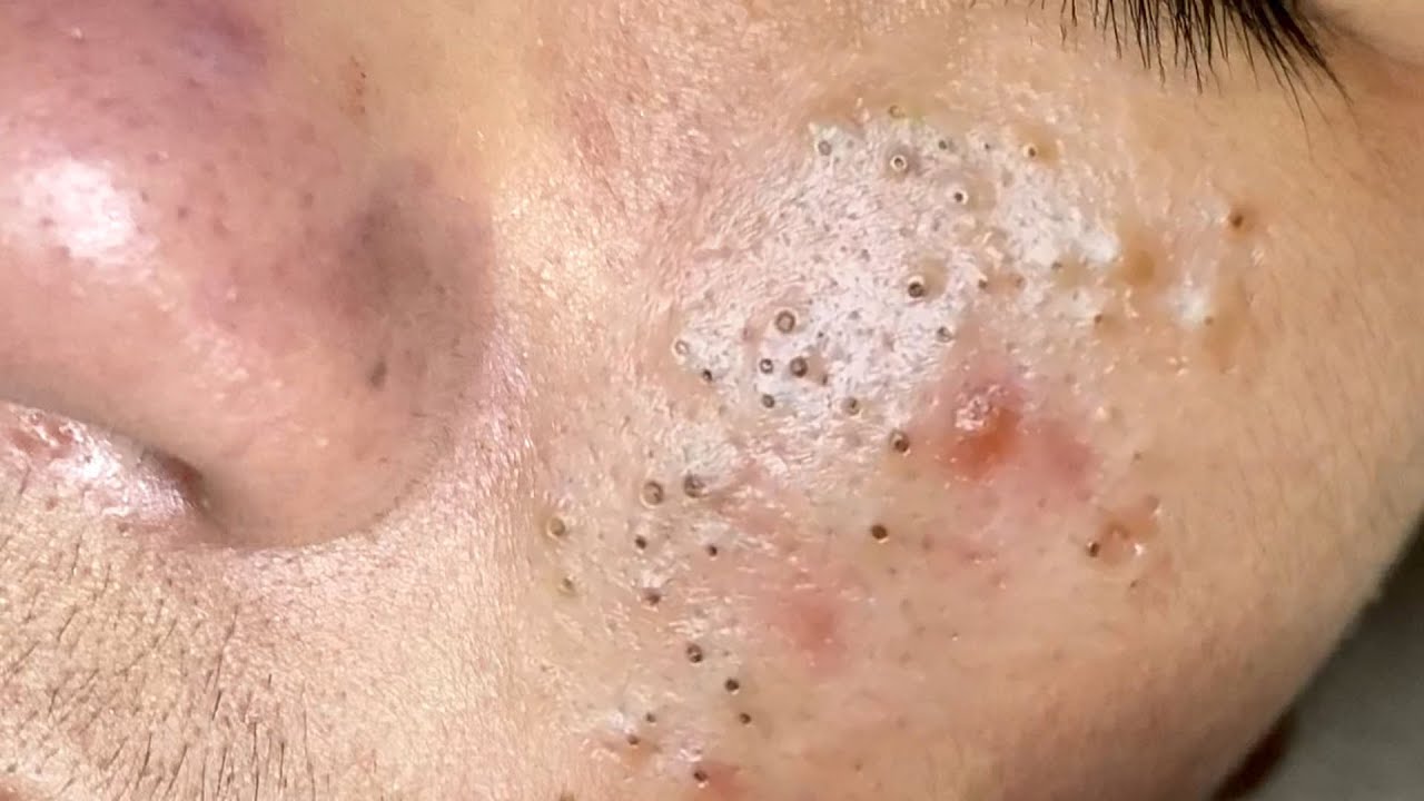 Suri Job #639: Great Inflamed Acne Extraction