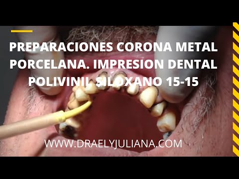 Corona Metal Porcelana - Art-Bucal