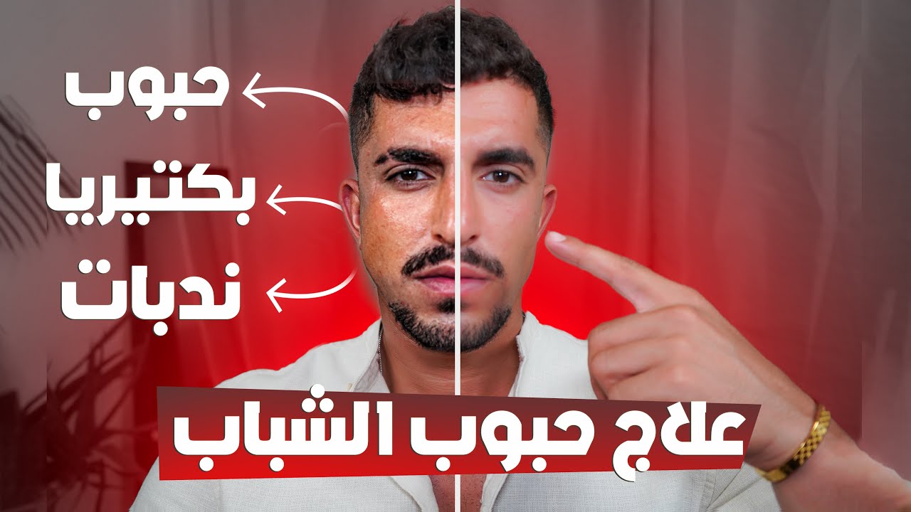 كيف تتخلص من حب الشباب نهائياً ❗(اسبابها وطريقة علاجها)