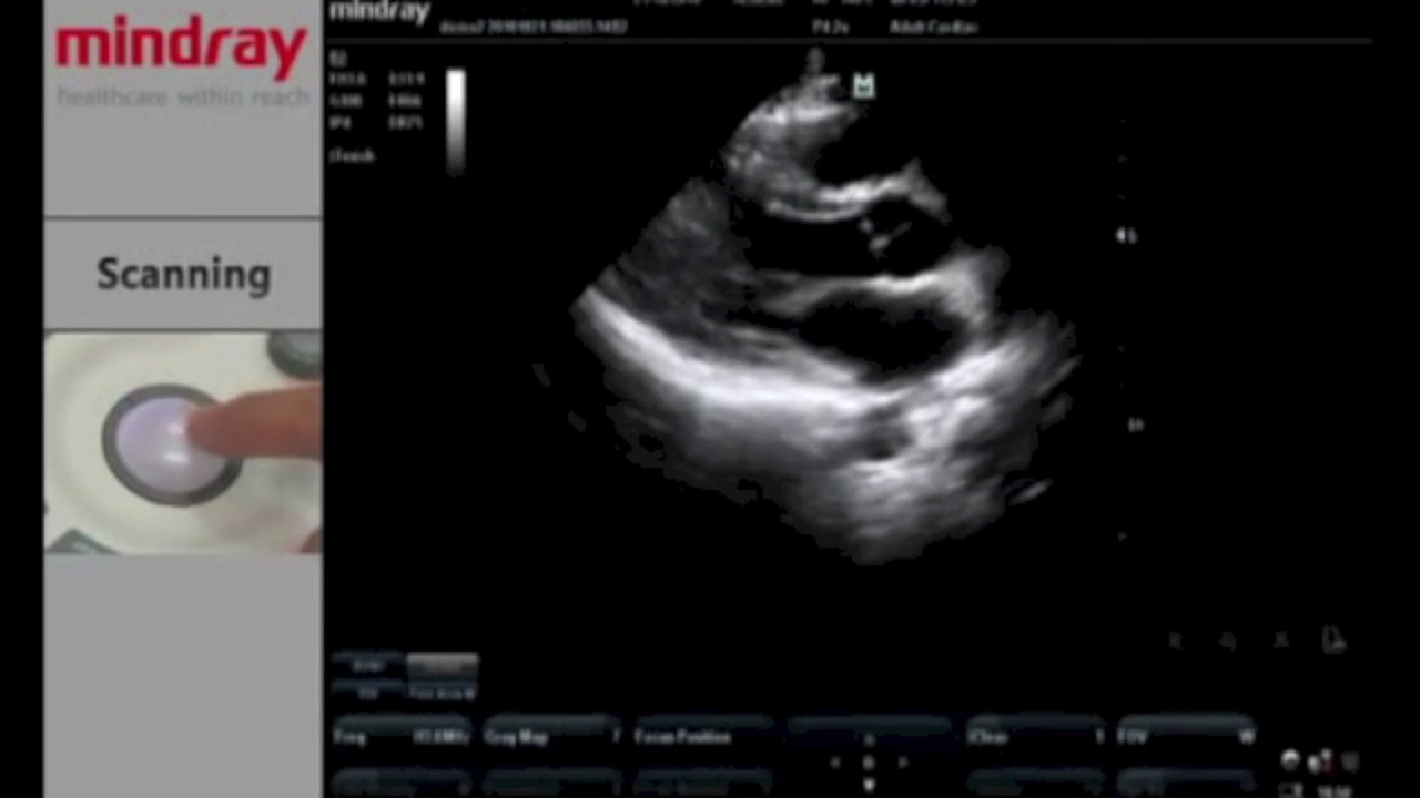 ECHOGRAPHE PORTABLE MINDRAY M7