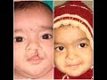 Smiling Pictures of Cleft Lip Children : Before & After Surgery Pictures (Dr. Jaideep Singh Chauhan)