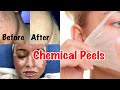 CHEMICAL PEEL TREATMENT | Glycolic Peel, Salicylic Peel & Lactic Peel | Chemical Peels In India