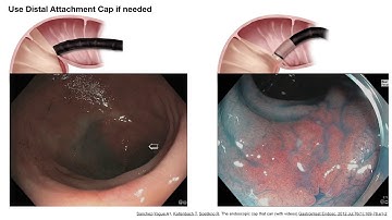 Colonoscopy: 5th Advanced Imaging Masterclass - IBD Cancer