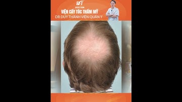 Cấy tóc tự thân có được vĩnh viễn không? | Dr Duy Thành