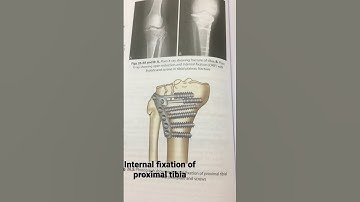 Internal fixation of proximal tibia #physiotherapy #yogitarehab #physio