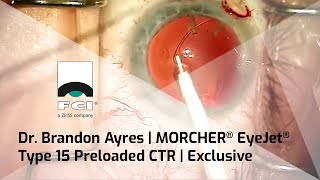Morcher Eyejet Type 15 Ctr Preloaded Ctr With Extra Curve Procedure Exclusive Fci Cataract