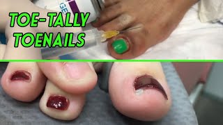 Toenail Double Feature!