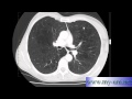 Emphysema on CT scan of Chest