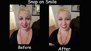 My Snap on Smile Before and After