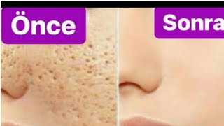 Gozenek Sikilistirici Sivilce Ve Akne Onleyici Arindirici Maske Etkisi Harika Youtube Cilt Bakimi Saglik Youtube Gozenek Sikilistirici Sivilce Ve Akne Onleyici Arindirici Maske Etkisi Harika Youtube Cilt Bakimi Saglik Youtube