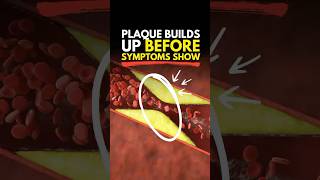 Plaque Builds Up Before Symptoms Show