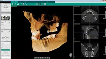 Clipping | Ez3D-i | Vatech