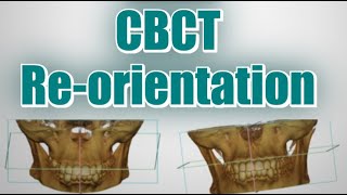 Implant Planning Basics  (Atomica AI) - Step 2. Check \& Adjust CBCT