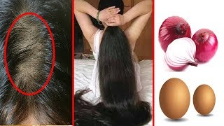 How To Grow Long and Stop Hair Fall With Onion & Egg !! Super Fast Hair Growth Challenge!