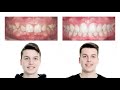 Tratamiento de ortodoncia maxilar y mandibular