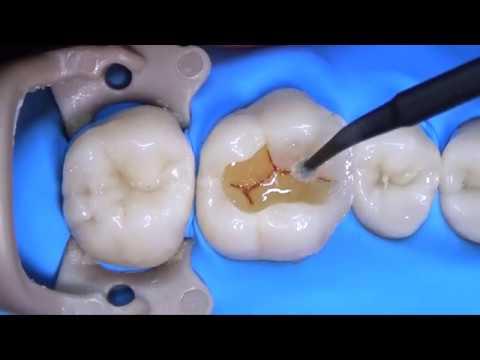 Step By Step Dental Filling Procedure - Dr. Elston Wong Dentistry