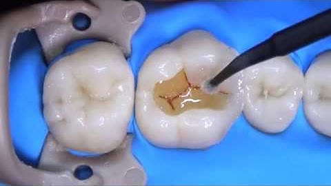 STEP BY STEP HOW TO DIRECT COMPOSITE RESTORATION WITH CLASS II SITUATION