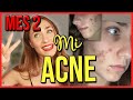 Mes 2 con ROACCUTAN - Isotretinoina | Mi ACNE | Juli Berea