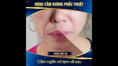 Tạo cằm V-line không phẫu thuật