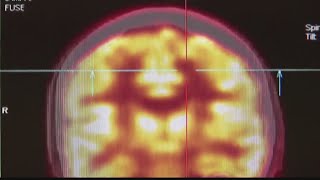 Actor's diagnosis puts spotlight on aphasia