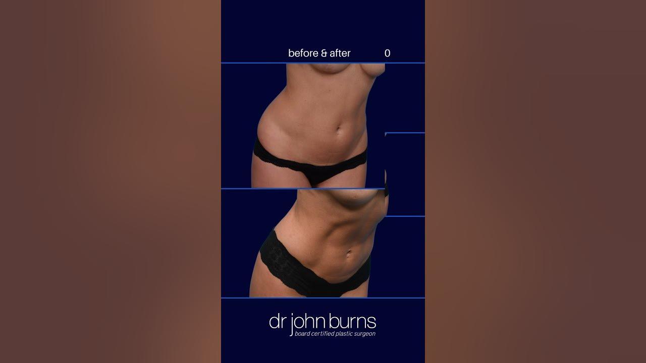Best Mini Tummy Tuck- Dallas-Top Plastic Surgeon, Dr. John Burns – Dr John  Burns