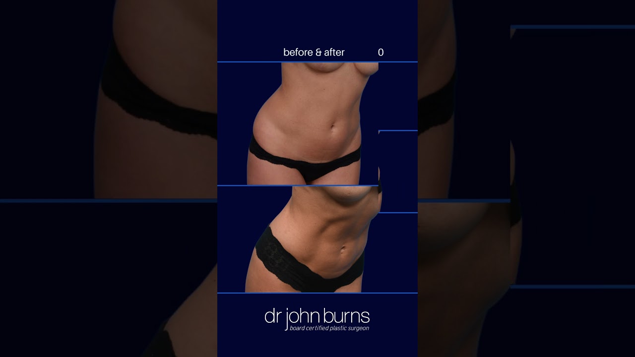 Dallas Mommy Makeover- Tummy Tuck + Lipo 360- Dr. John Burns – Dr John Burns