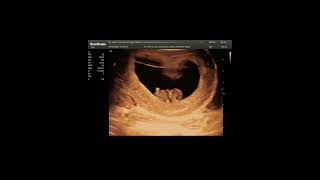 Embarazo: Ultrasonido de 9 semanas.