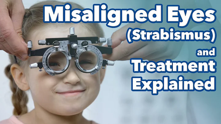 Misaligned Eyes (Strabismus) and Treatment Explained. What is Strabismus? - DayDayNews