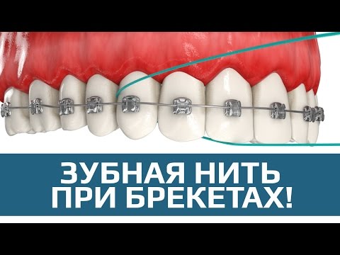 Флосс. Как правильно пользоваться зубной нитью при брекетах