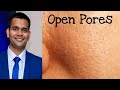 How To Get Rid Of Open Pores Permanently | open pores on face Treatment