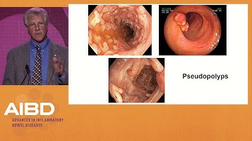 How to use chromoendoscopy and high definition white light endoscopy