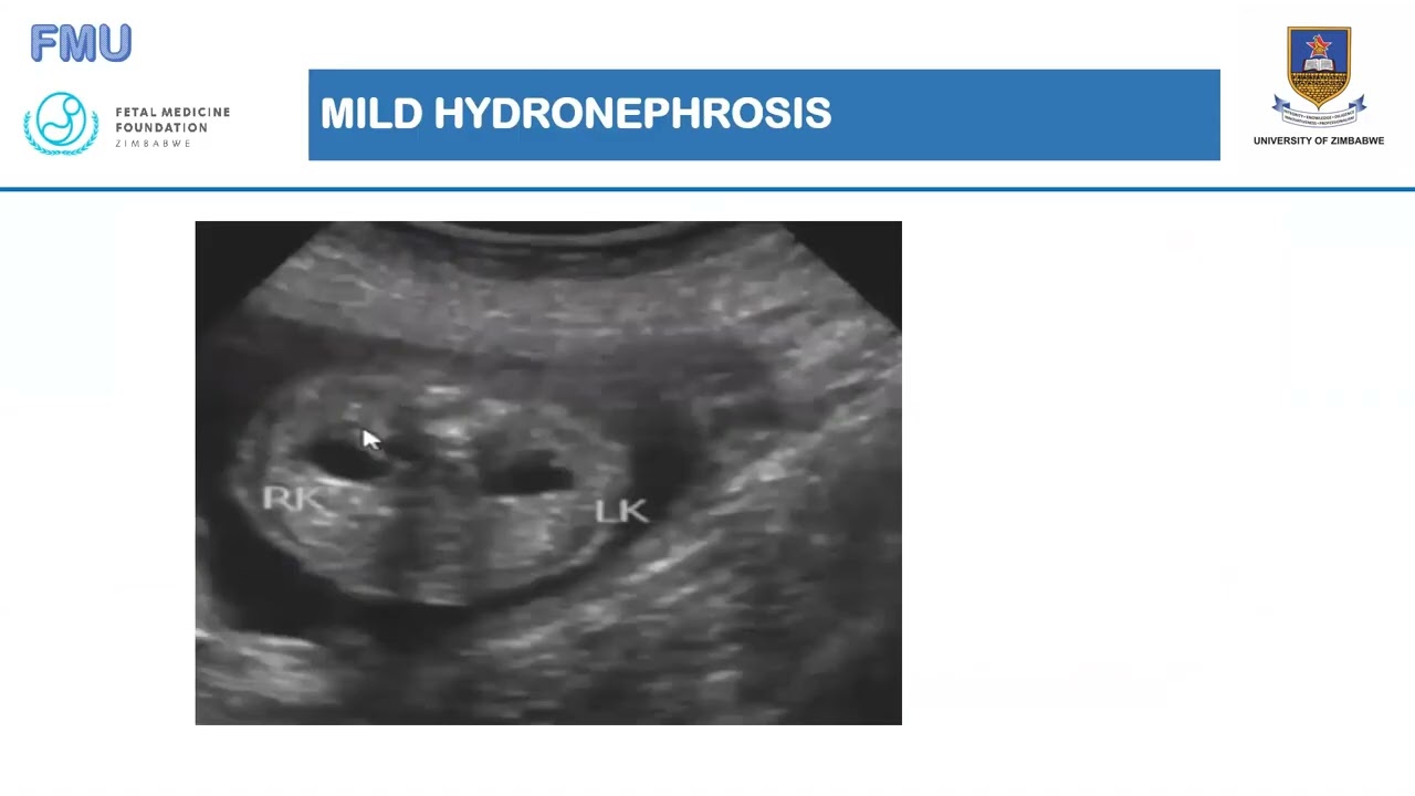 ANEUPLOIDY SCREENING by DR CHIRUME