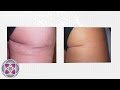 Laser Scar Removal Treatment - Get Rid of Scars