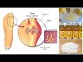 How to Lower Uric Acid Naturally