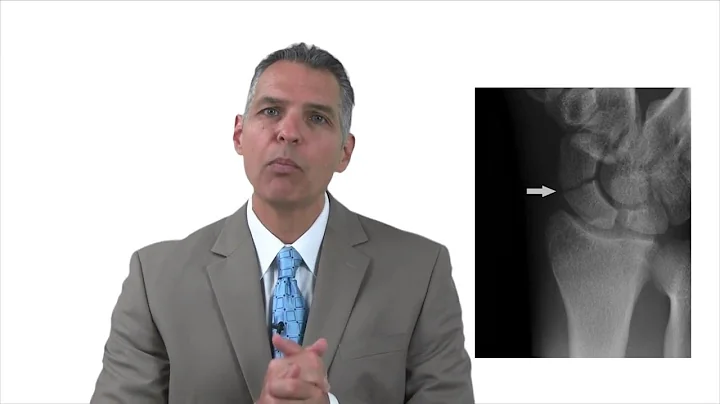 Scaphoid injury after an Indiana Accident | Michigan City Personal Injury Lawyer